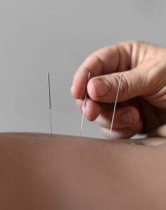 Acupuntura